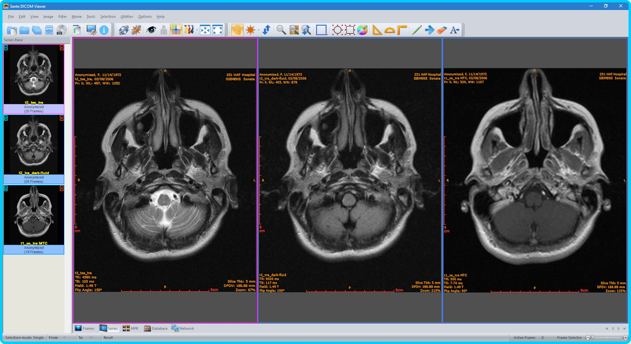 Программа для мрт снимков. Dicom viewer 3.1.4. Sante Dicom viewer Pro. Dicom Формат. Формат мрт файла на диске.