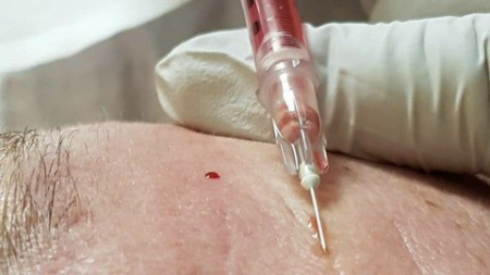 Vampire Facials (Platelet Rich Plasma)