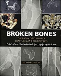 Broken Bones The Radiologic Atlas of Fractures and Dislocations Ed 2
