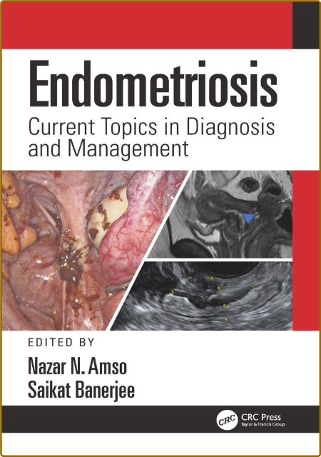 Amso N  Endometriosis  Current Topics in Diagnosis   2022