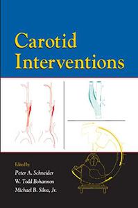 Carotid interventions