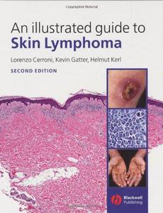 An Illustrated Guide to Skin Lymphoma, Second Edition